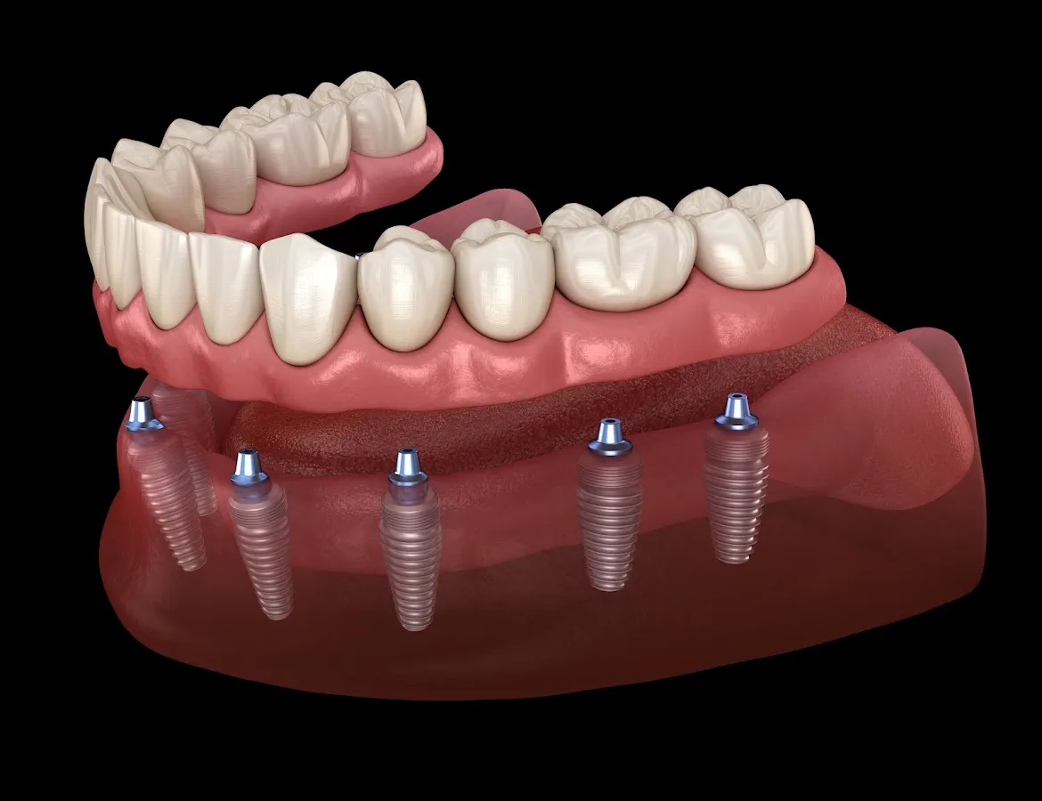 Gordon Dental Implants and Cosmetics
