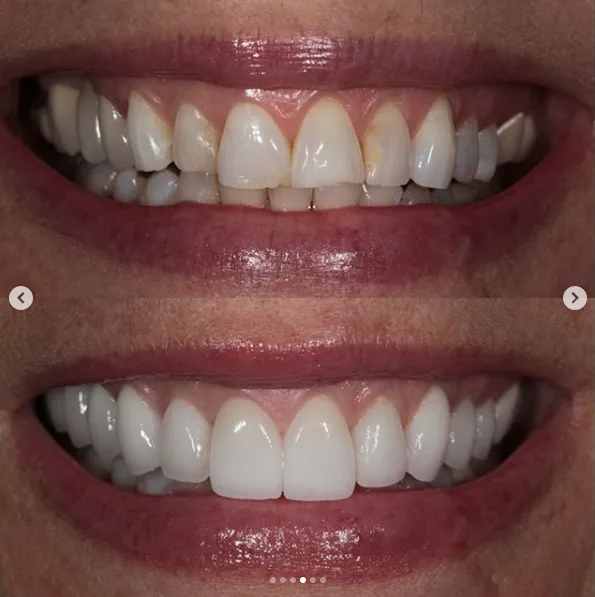 The Smile Code: A Practical Visitor Guide for Invisalign, Crowns, and Smile Makeovers